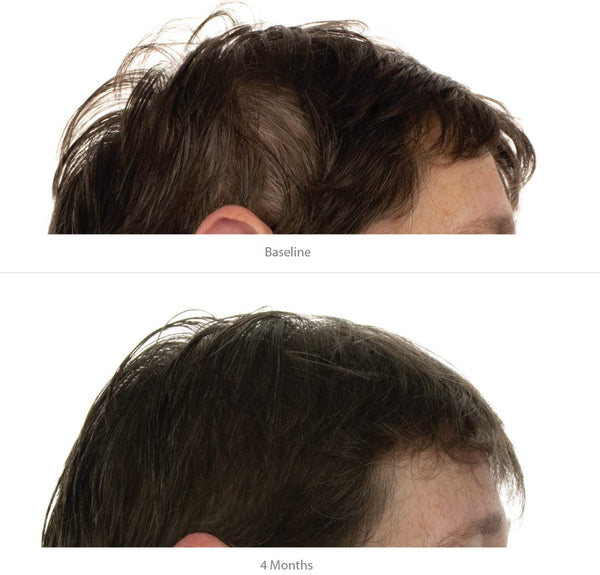 FOLIGAIN Hair Growth Shampoo + Conditioner Kit For Women - FOLIGAIN